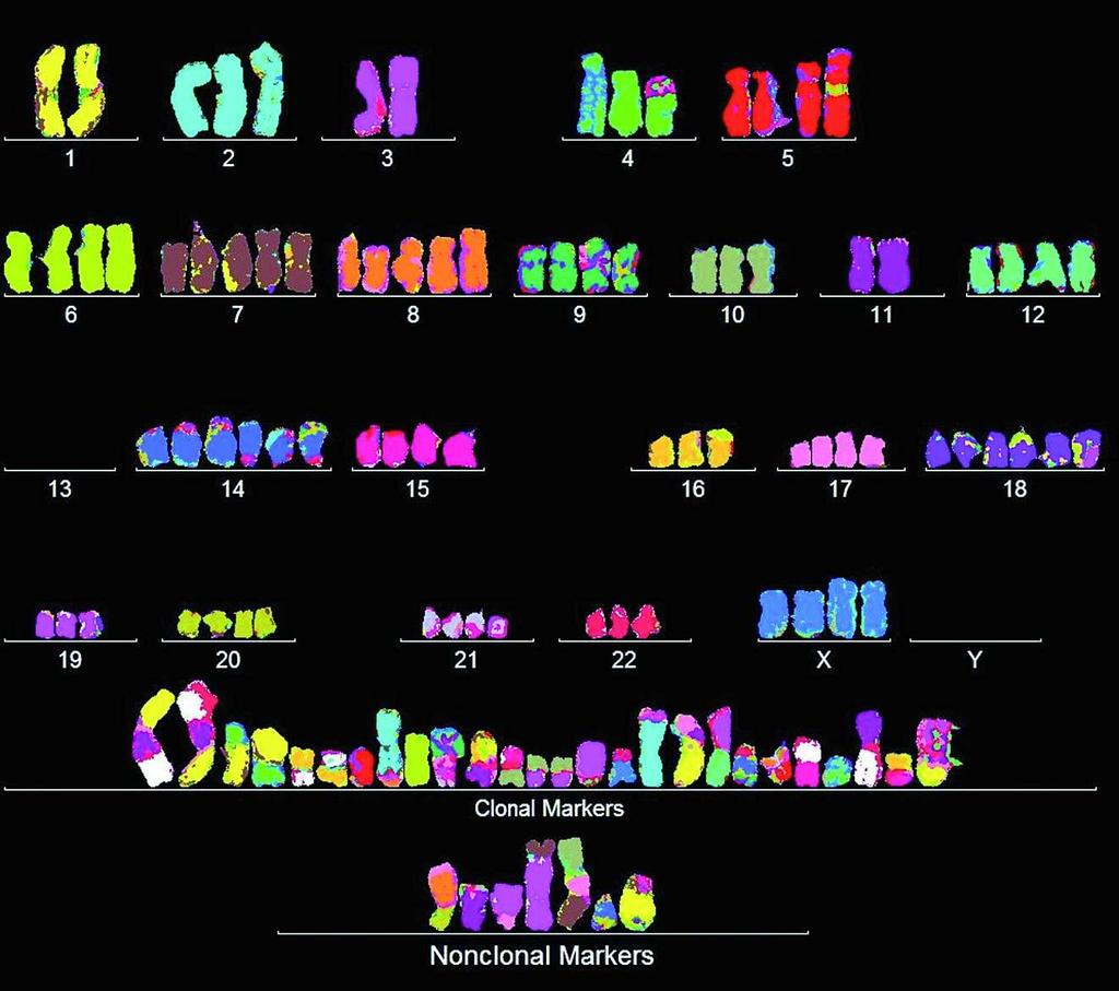 Abbildung 5 Fehlerhafter Chromosomensatz einer Krebszelle.
