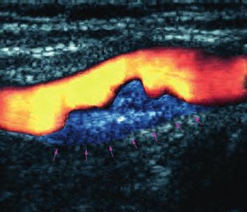 Momentaufnahme: Eine Ablagerung (Plaque; im Bild blau) behindert den Blutfluss. weiteren Risikofaktor haben.
