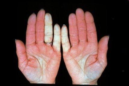 vaskuläre Manifestationen Raynaud-Syndrom Symptome: o attackenförmiges Abblassen einzelner Finger, anschließend