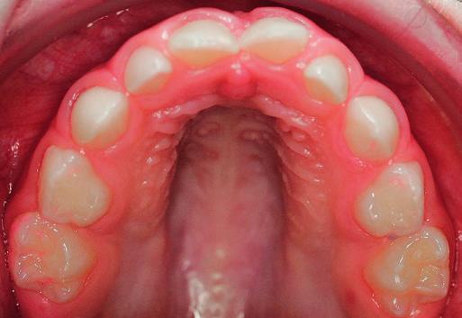 Zahnerhaltung // Fachbeitrag a b Abb. 6a, b: Das Ziel der Kariesprävention sind langfristig gesunde Zähne.