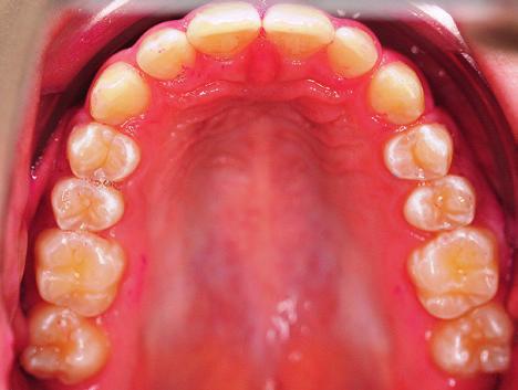 Schmoeckel, mit freundlicher Genehmigung) tion essenziell und dies kann am besten über regelmäßiges Zähneputzen mit fluoridhaltiger Zahnpasta gewährleistet werden.