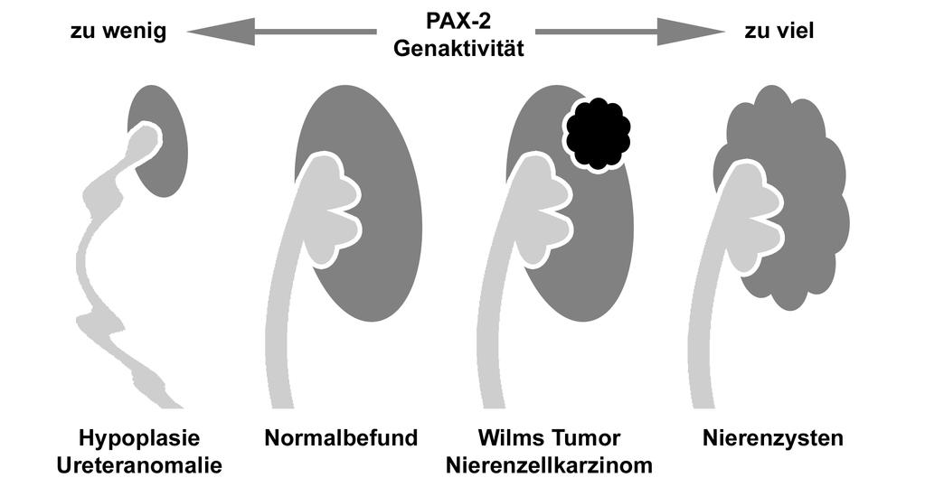 Einleitung Abbildung 0.7 PAX-2 Genaktivität bei verschiedenen Störungen Eine herabgesetzte Expression von PAX-2 führt zu renalen Entwicklungsdefekten.