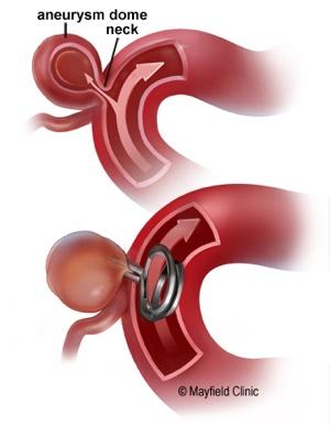 Mikrovaskuläres Clipping: Links: pterionale Kraniotomie und Clip auf Aneurysma; rechts: verschiedene Formen von Aneurysma-Clips Endovaskuläres Coiling Abbildungen aus: https://www.