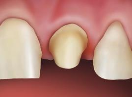 Schritt 6: Provisorische Restauration entfernen. Präparierten Zahn mechanisch reinigen (z.b.