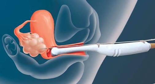 Ovarielle Stimulation - Risiken ü Komplikationen der ovariellen Punktion < 1 % Eizellentnahmen gesamt