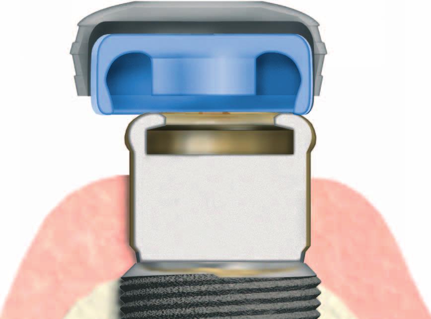 Geringe vertikale Höhe Astra Tech Implantate haben eine konische Innenverbindung zwischen Implantat und Abutment das Conical Seal Design.