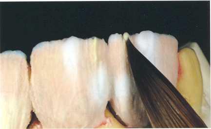 ceram (Degussa Dental) in der Okklusion.