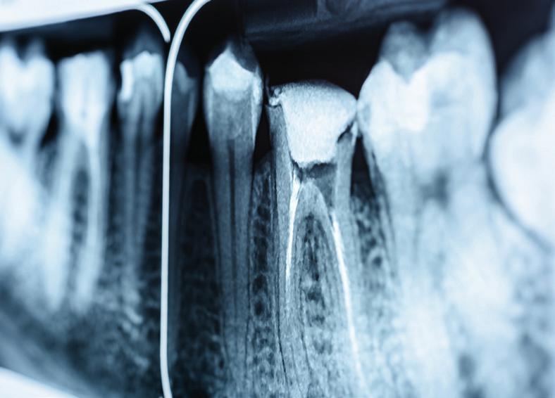 ENDODONTIE/KONS SEKUNDÄRBEHANDLUNGEN // Weltweit werden jedes Jahr Millionen Zähne mit Erkrankungen der Pulpa oder des periradikulären Gewebes durch Wurzelkanalbehandlungen gerettet.