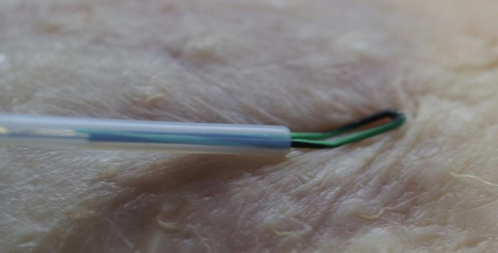 Die Schneidelektrode richtet sich automatisch, also ohne Manipulationen am proximalen Ende des Katheters, vertikal zur jeweiligen Gewebeoberfläche aus.