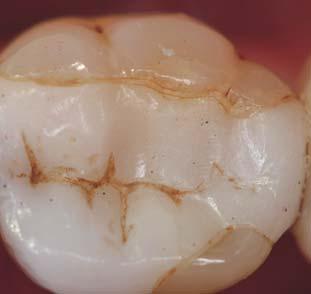 Zahnmedizin Restaurative Zahnheilkunde Teilkronen aus Keramik ein Therapiekonzept im Fluss Priv.-Doz. Dr.