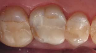 Zahnmedizin Restaurative Zahnheilkunde Abb. 3a Abb. 3c Abb. 4a flächenbemalung ist optional. Die Lithiumdisilikatkeramik kann alternativ als Gerüstmaterial verwendet und verblendet werden.