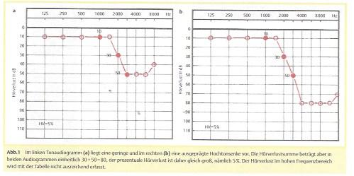 Anwendung der tonaudiometrischen Hörverlust-Tabelle Tabelle von Röser (1980): Der prozentuale Hörverlust wird aus dem Hörverlust bei
