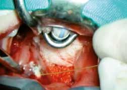 /Chirurgie hhsanfte Verkleinerung der Nasenmuscheln hhepistaxis-behandlung hhpolypen-/ Papillom