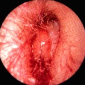 Otitis externa maligna Dr.