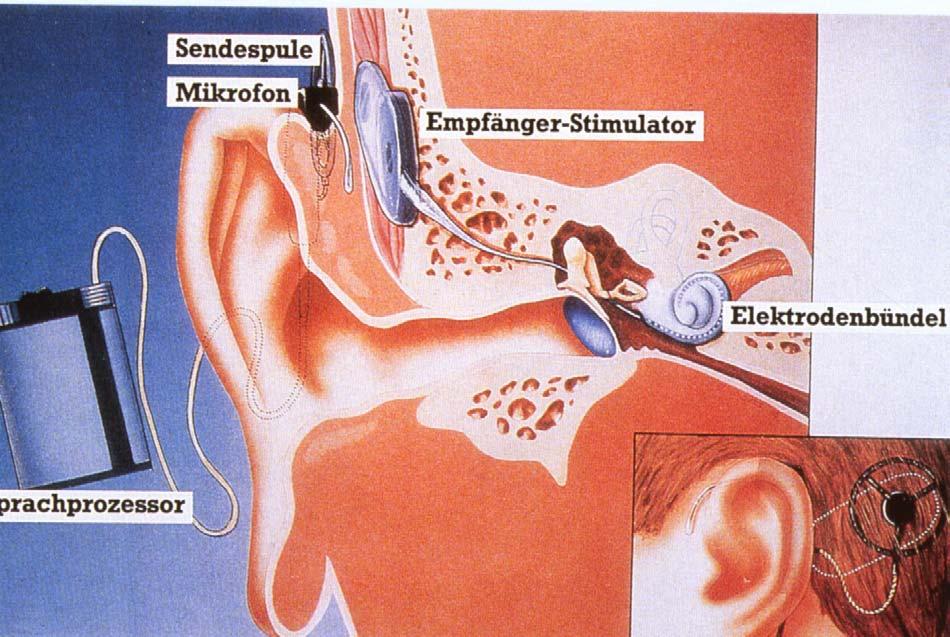 TICA + Cochlea-Implant Dr.