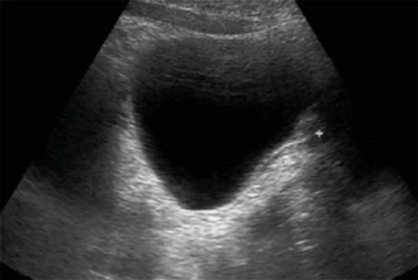 KORASION Abb. 4: Abdomensonographie, Längsschnitt, Uterusaplasie Unter einer zunächst oralen Östrogen-, später zyklischen Östrogen- Gestagen-Substitution zeigte sich nur ein minimales Brustwachstum.