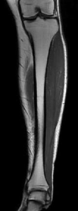 section through the leg (MRI scan). (From Heuck et al., MRT-Atlas, 009.) 8 Deep flexor muscles of leg and foot (right side, posterior oblique-medial aspect).