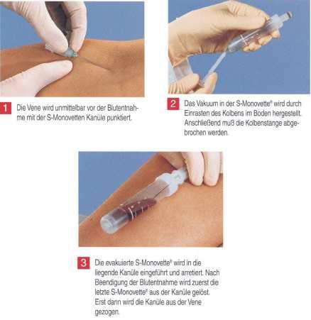 2: Vakuumprinzip zur Entnahme einer Blutprobe