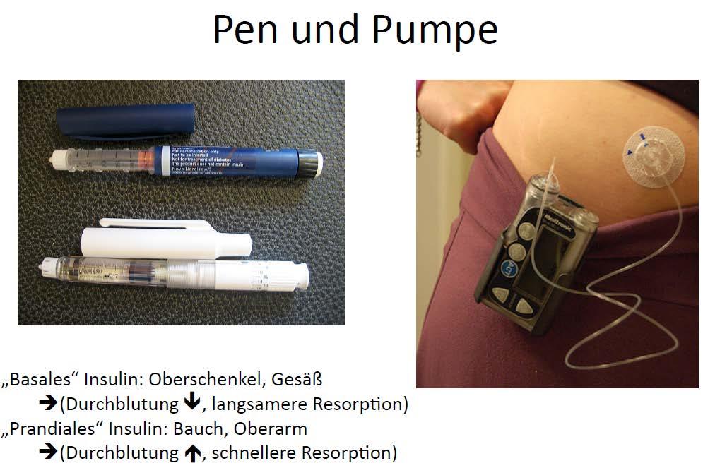 Indikation Pumpe: - Diabetes bei Schwangeren -