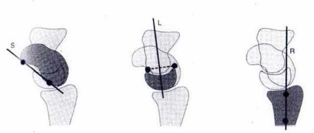 Abbildung 6: Darstellung der karpalen Achse mit der Tangentialmethode 46 S = Tangente entlang der palmaren Facette des Os skaphoideum L = Senkrechte auf die Verbindungslinie der Hörner des Os lunatum