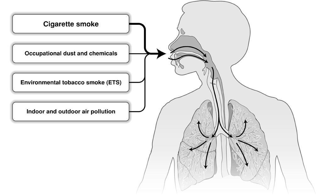 COPD -