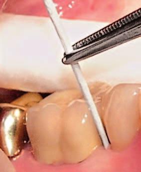 Abb. 1 Sondierung. Abb. 2 Probeentnahme. über 35-Jährigen 1 und nach der Karies ist die Parodontitis die zweithäufigste Erkrankung im Zahn-, Mund- und Kieferbereich 2.
