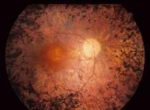 Weitere wichtige Sehbehinderungen Hochgradige Myopie ab 10dpt - Netzhautablösungen und Glaukom möglich Retinopathia pigmentosa -