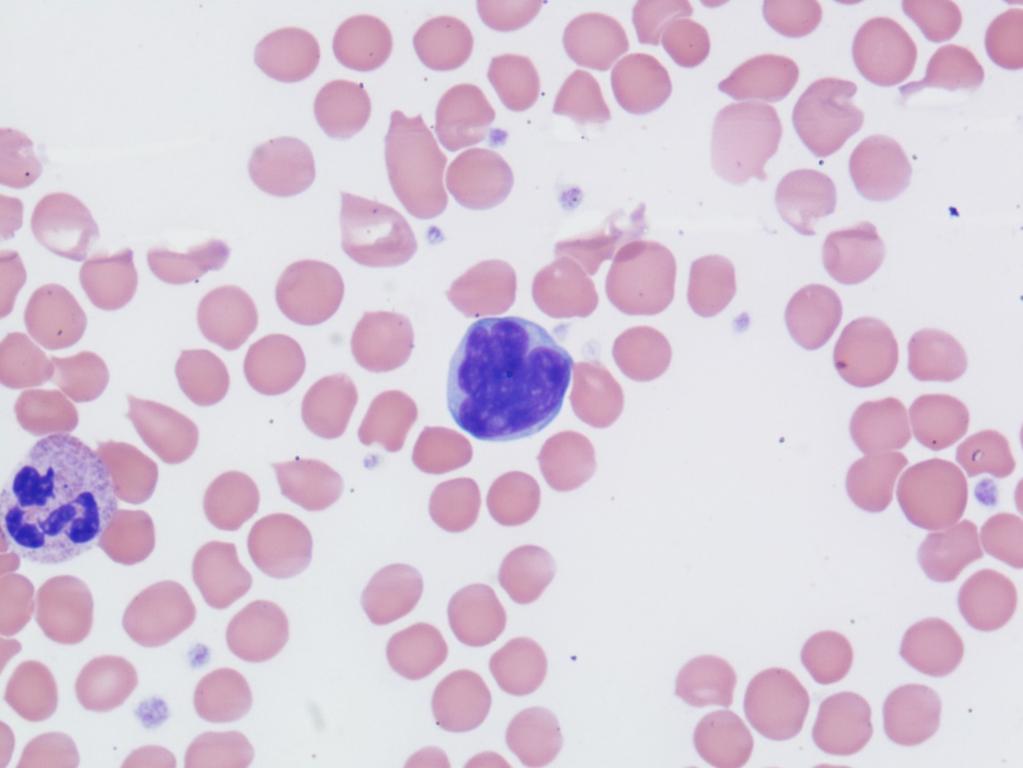 Abb.6 Die Kombination mit der Eosinophilie legt den Verdacht nahe, dass es sich um ein T-Zellen Lymphom handeln könnte, die auffällig konfigurierten Kerne lassen ein Sezary-Syndrom vermuten.