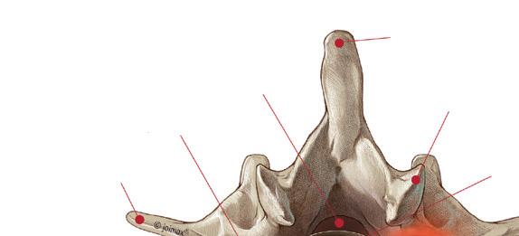 Spinalkanal Spinalnerv Querfortsatz Dornfortsatz Facettengelenk Rückenmark Gallertkern Faserring Bandscheibenvorfall Wirbelkörper Ansicht von oben Vor der Operation wird Ihr Arzt Sie zunächst
