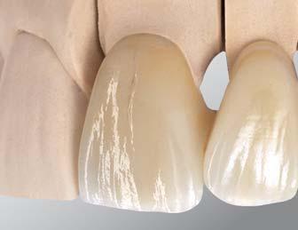 Schichtschema Dentinkern-Krone nach Schweiger Z Opal Incisal 1 und 2 Mit den Opal Incisal Massen können