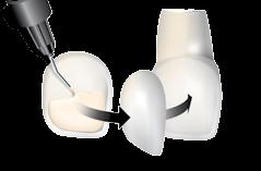 Zahnersatzes Verblockung, Schienung von gelockerten Zähnen Handelsformen Vorteile Das weltweit erste rein keramisch basierte fließfähige Füllungsmaterial Pure Silicate Technology, d. h.