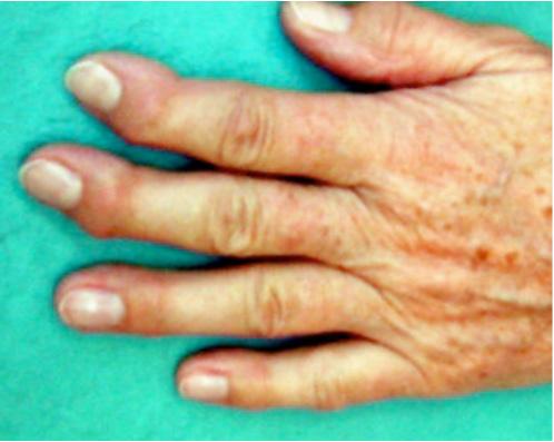 Abb.1: Typisch arthrotisch veränderte Finger Abb.