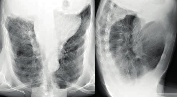 Lungenkrebs und Mesotheliom des Rippen- und Bauchfells: Die jahrzehntelange Reizwirkung der eingeatmeten Fasern kann im