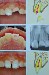 wissenschaft Milchzahnendodontie in der Zahnarztpraxis Ein Beitrag von Professor Dr.