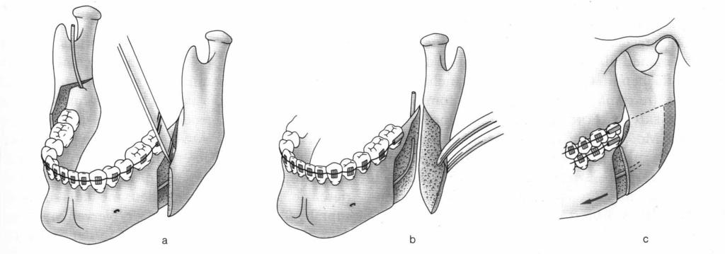 5 Aussenkompakta des Kieferwinkels und ein distales Segment, das den Alveolarfortsatz mit den Zähnen trägt.