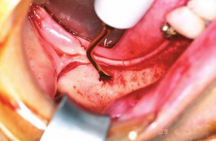 TiN-Beschichtung Scharfkantig 0, 5 mm dick Einseitige Knochengewinnung aus der Mandibula anterior