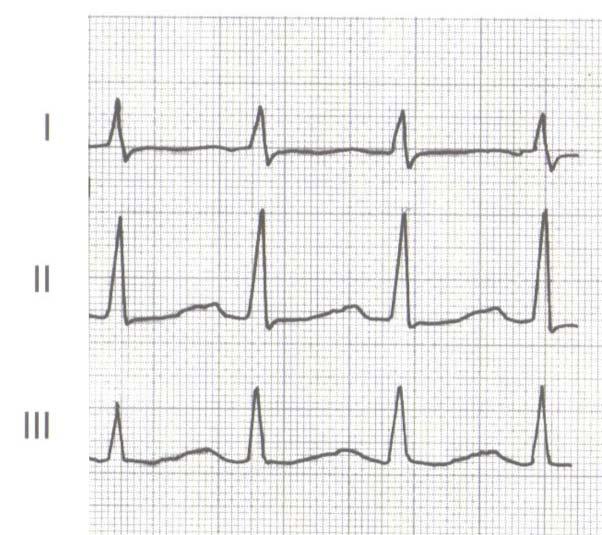 9 14. Zeichnen Sie die idealisierte Normalform des EKG bei Standardableitung II nach Einthofen.