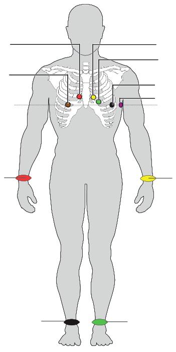 IEC-Beschriftung AHA-Beschriftung EKG-Patientenkabel anschließen C1, rot V1, rot Vierter Interkostalraum, rechter Sternalrand C2, gelb V2, gelb Vierter Interkostalraum, linker Sternalrand C3, grün