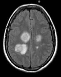 Plasmaseparation - ADEM Acute disseminated encephalomyelitis (ADEM) is an immune-mediated inflammatory demyelinating condition that predominately affects the white matter of the brain and spinal cord.