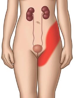 stechende Schmerzen im Lenden- und Flankenbereich (an der Körperseite, von den Rippen bis zur Hüfte). Eventuell verspüren Sie auch Schmerzen in der Leistengegend oder im Oberschenkel.
