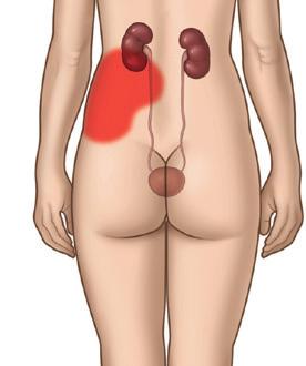 Nierenkoliken können von folgenden sonstigen Symptomen begleitet sein: Übelkeit Erbrechen Blut im Urin (Urin ist rosa gefärbt) Schmerzen beim Wasserlassen Fieber Bei einer Nierenkolik handelt es sich