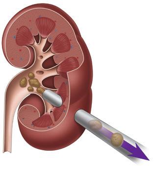 Nierensteine Nephroskop Abb. 5b: Steinfragmente werden in einem einzigen Eingriff mit einem Nephroskop entfernt.