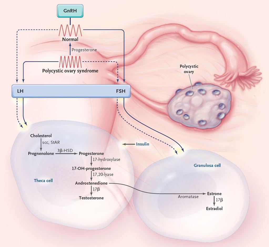PCOS 15 Abbildung 1: Pathogenese des PCOS 2.2.2 Insulin Insulin fördert die Entstehung von Hyperandrogenämie beim PCOS in doppelter Hinsicht.