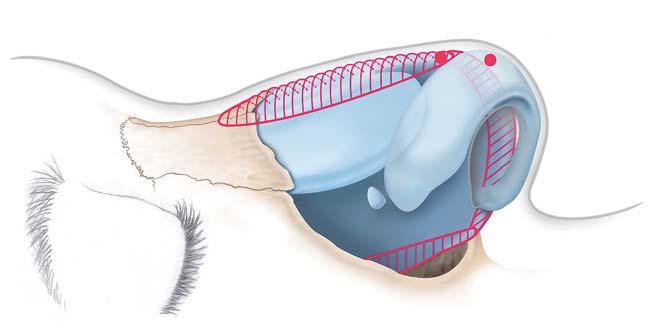 I Fachbeitrag _ Rhinochirurgie _Hyperplasie des Septumknorpels in dorso-lateraler Richtung oder des Vomer, Polly beak Eine Hyperplasie des Septumknorpels in dorso-lateraler Richtung