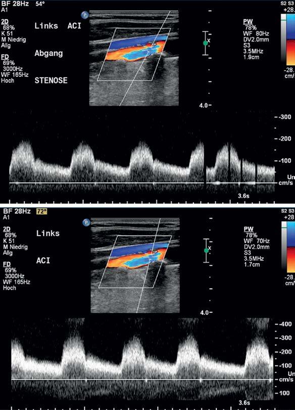 Untersuchungsgang intrakranieller Gefäßabschnitte Eine Übersicht der Schallfenster und der zu untersuchenden Gefäße gibt Tab. 3 wieder.