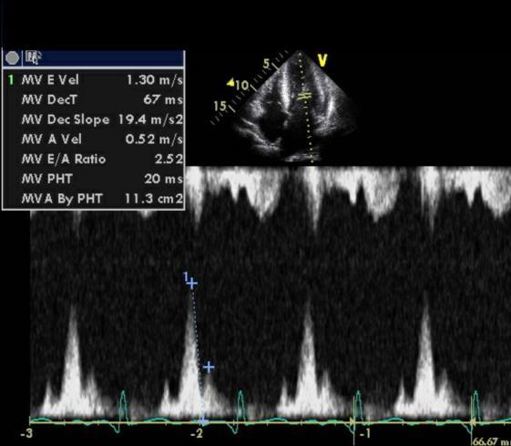 Lungenödem bei HFpEF und