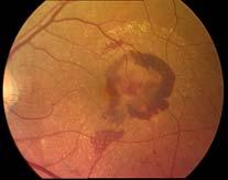 Abbildung 1 zeigt die anatomischen Verhältnisse des Auges im Überblick. Im Bereich der Makula ist die höchste Dichte der Photorezeptoren. Der größte Teil der Lichtbelastung wird auf diese ca.