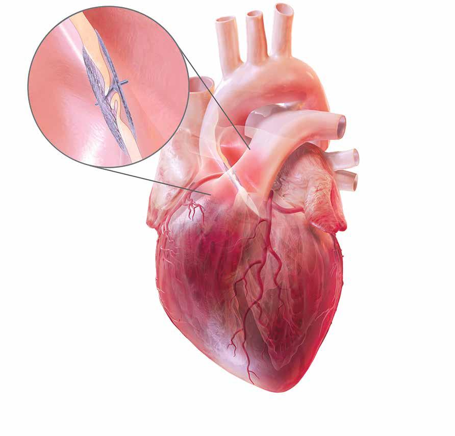 Bei einem offenen Foramen ovale kann sauerstoffarmes Blut direkt vom rechten Vorhof an der Lunge vorbei in den linken Vorhof gelangen und sich mit sauerstoffreichem Blut vermischen