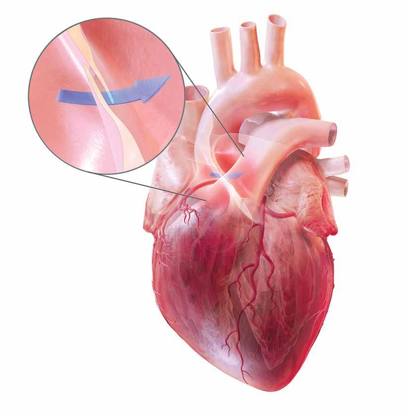 Im normalen Herzen (ohne PFO) würde ein Blutgerinnsel im Körper von der Lunge herausgefiltert und gestoppt werden.