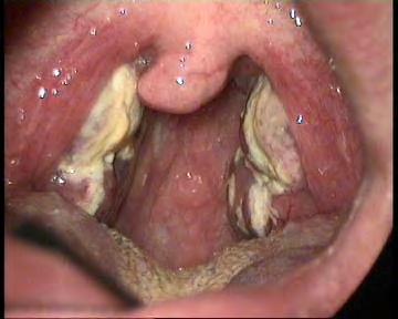 Tonsillitis Äth.: Symtome: Kompl.